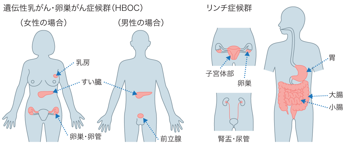 がんのゲノム医療<